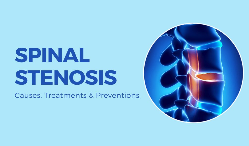 Spinal Stenosis | Causes, Treatment & Preventions