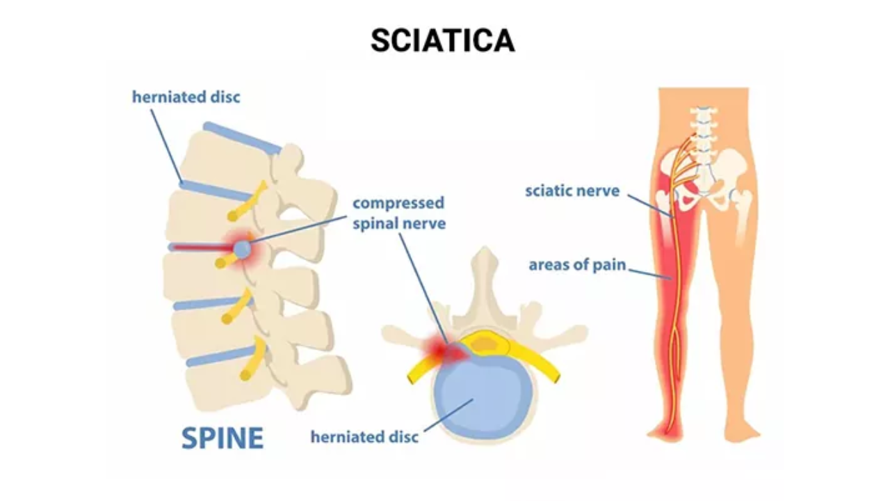 Physiotherapy for Sciatica and Nerve Pain in Islamabad