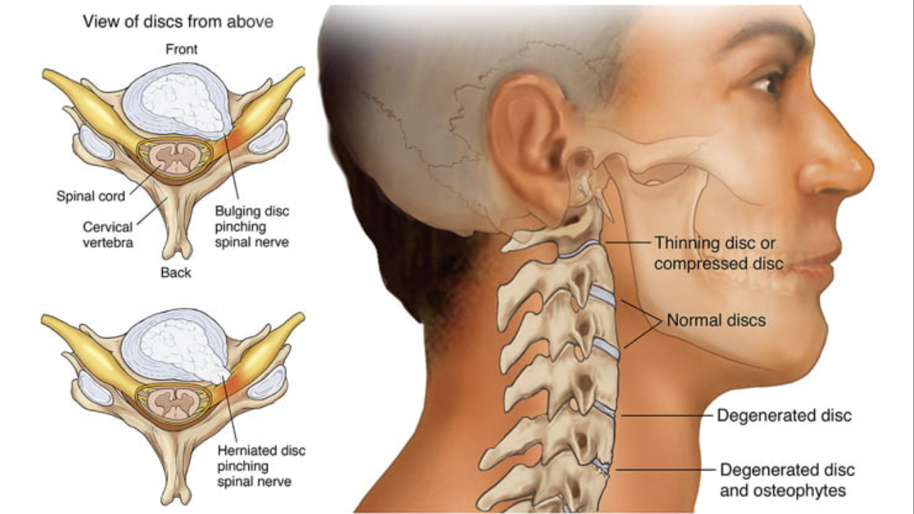 Disc Bulge and Slip Disc Treatment in DHA Phase 2 Islamabad: Non-Surgical Recovery at Theramed Neuro Therapies