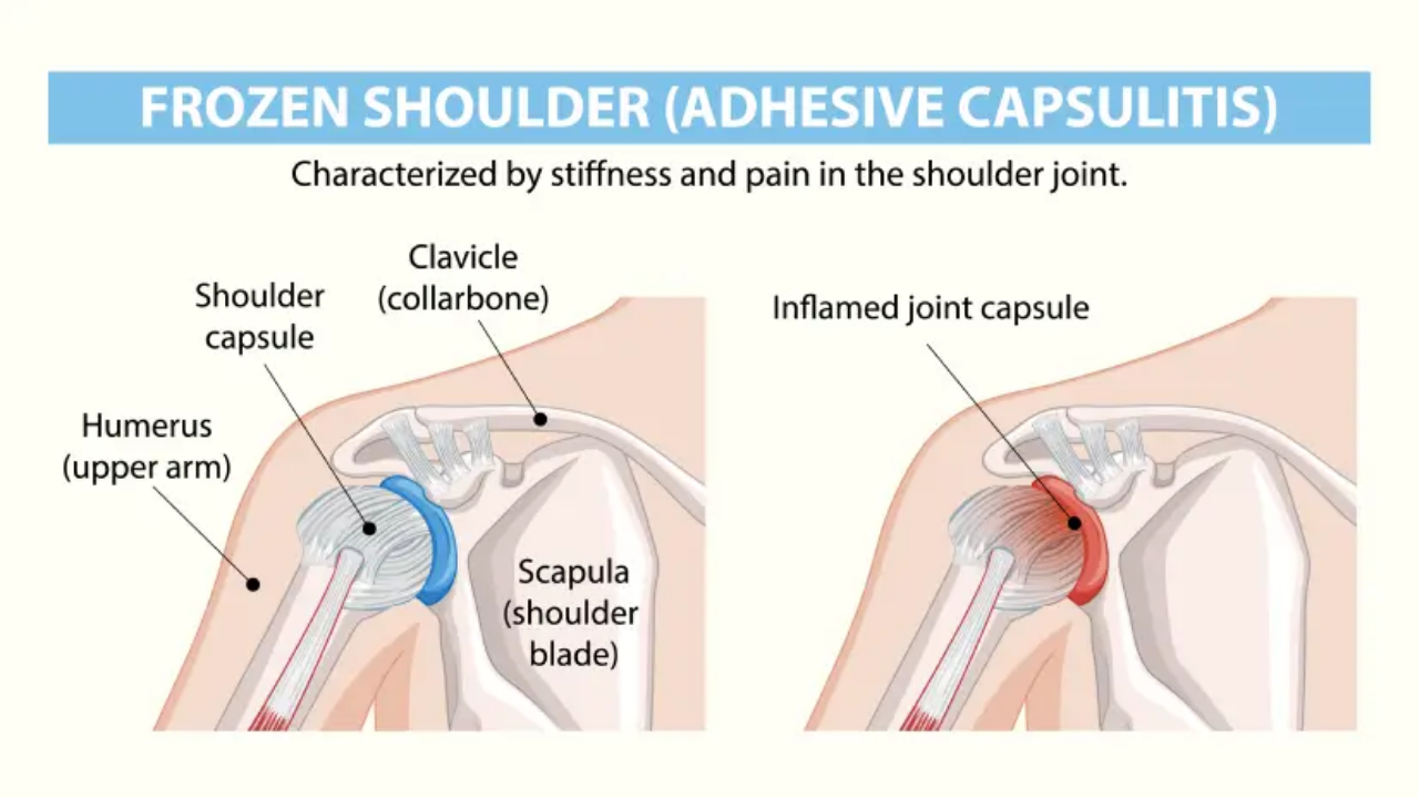 Non-Surgical Frozen Shoulder Treatment in Media Town Islamabad | Advanced Physiotherapy at Spire Medical & Rehabilitation Center