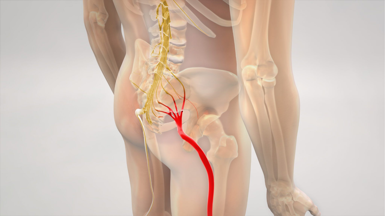Non-Surgical Sciatica Treatment in Media Town Islamabad | Advanced Physiotherapy at Spire Medical & Rehabilitation Center