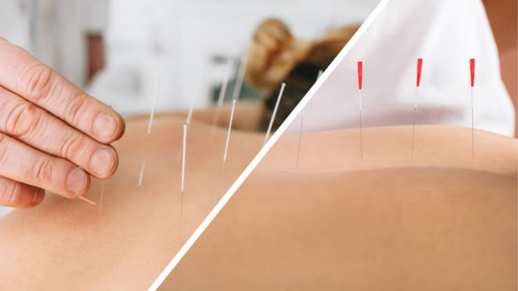 Dry Needling Therapy in Islamabad – Advanced Treatment for Chronic Muscle Pain and Trigger Points