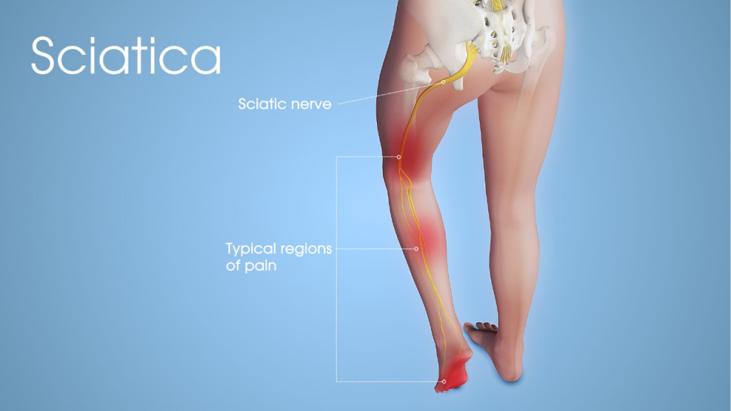 Sciatica Pain Treatment in Islamabad – When Leg Pain Starts in Your Lower Back